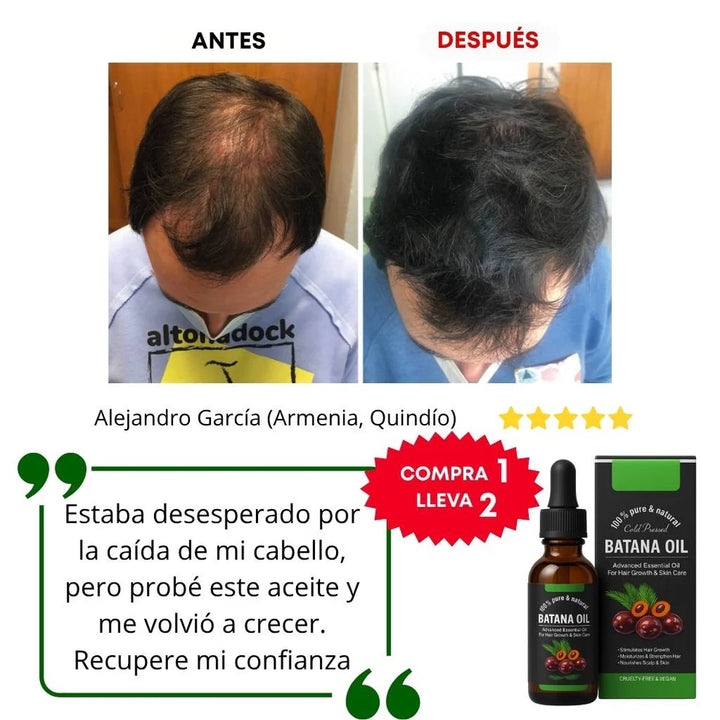 Aceite de Batana – Anti-Caída y Regenerador Capilar(PAGA 1 Y LLEVA 2)💯🎁